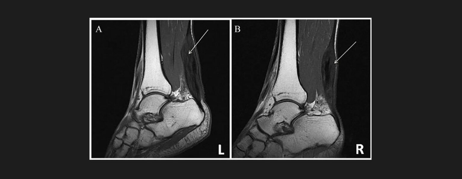 Achilles Tendonitis