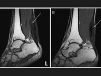 Achilles-Tendonitis-2