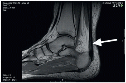 Achilles Tendinopathy Illustration