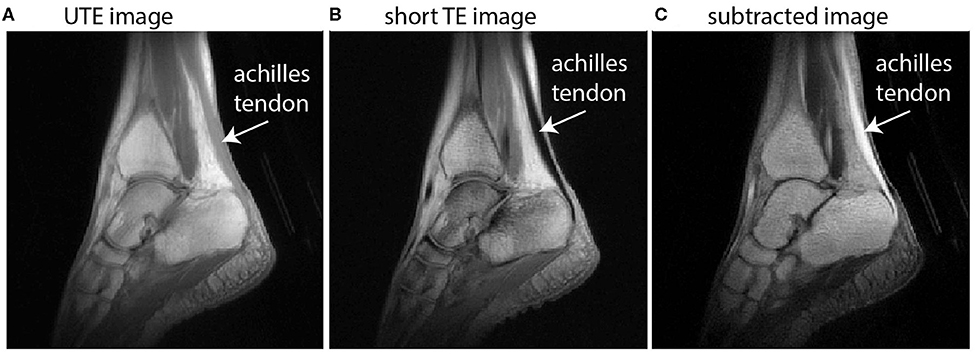 Achilles Subtendon Structure